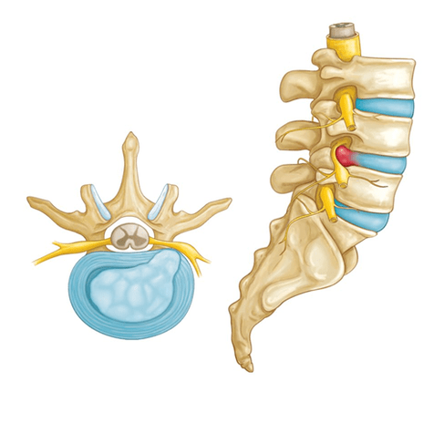 back pain due to intervertebral hernia