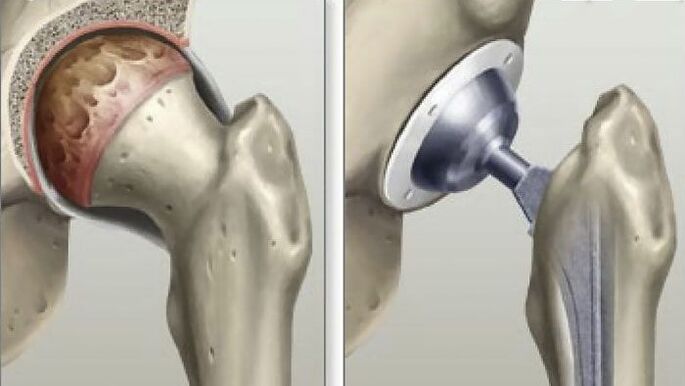 In the final stages of coxarthrosis, hip replacement is performed