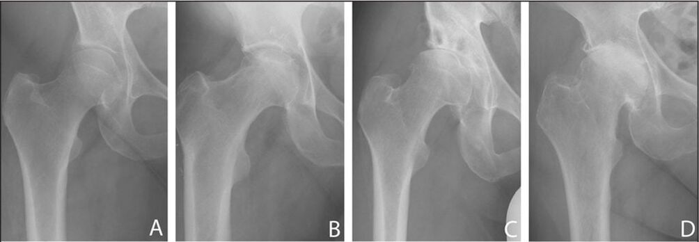 Stages of development of hip joint arthrosis on X-ray