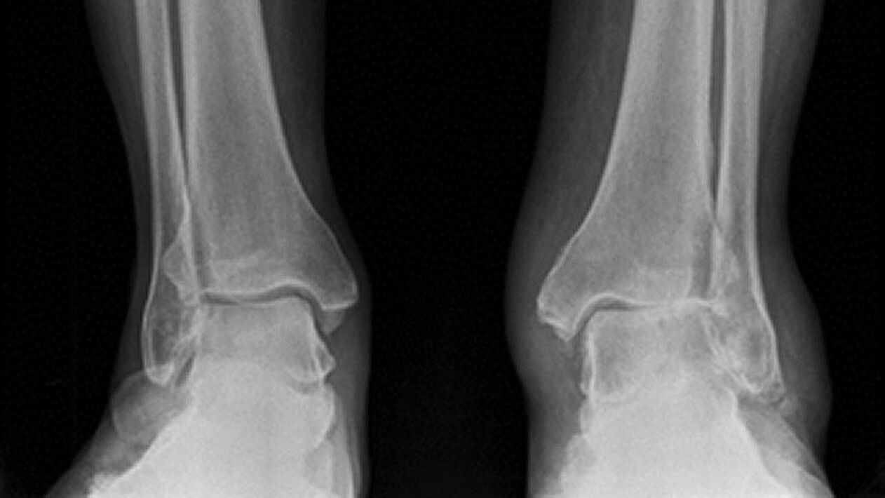 ankle x-ray