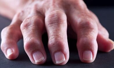 What is the difference between arthrosis arthritis
