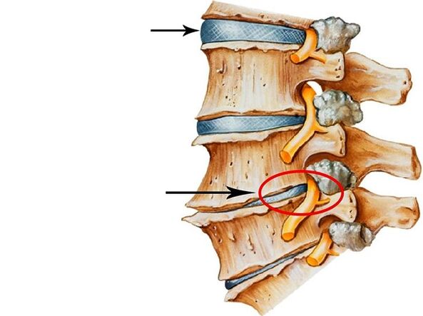 Disorders on intervertebral disks