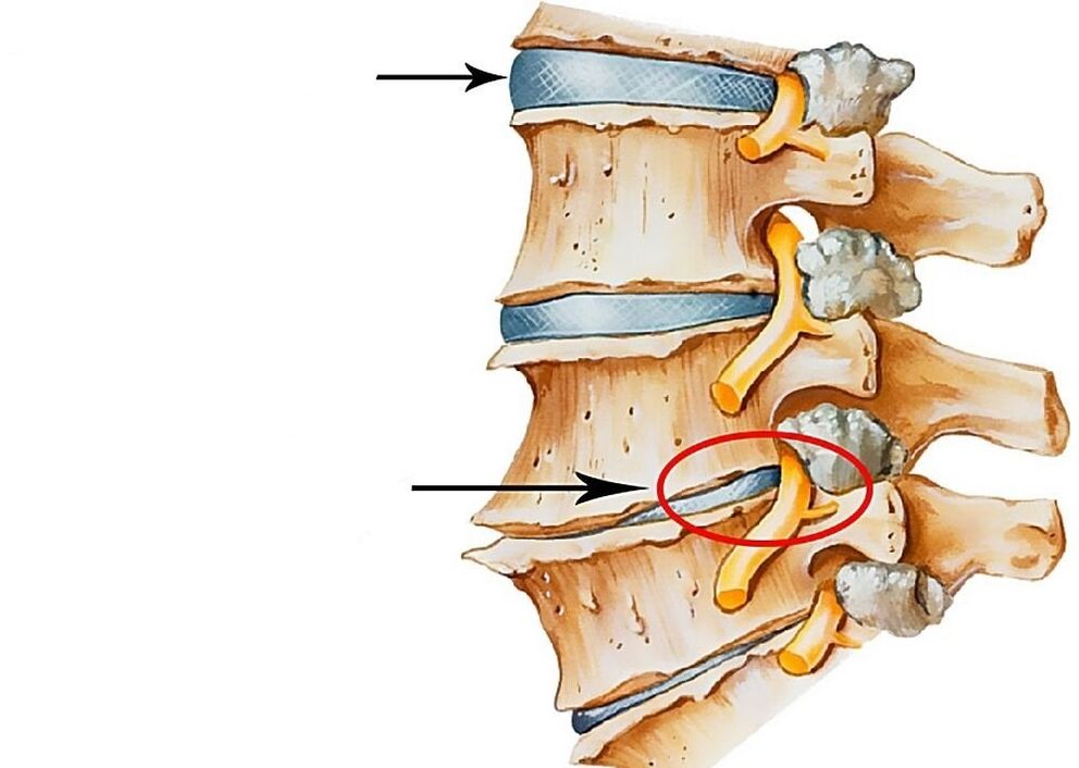 description of healthy and deformed spinal discs
