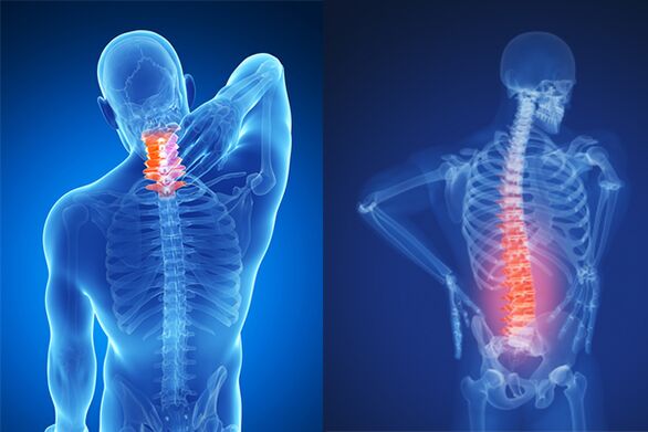 Osteochondrosis of the cervical and lumbar spine