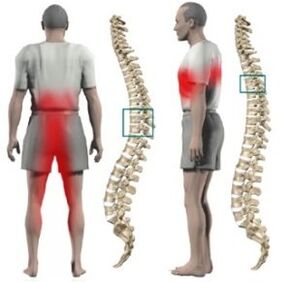 Spinal protrusions