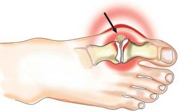 Inflammation of the joint between the big toe and the foot due to arthritis