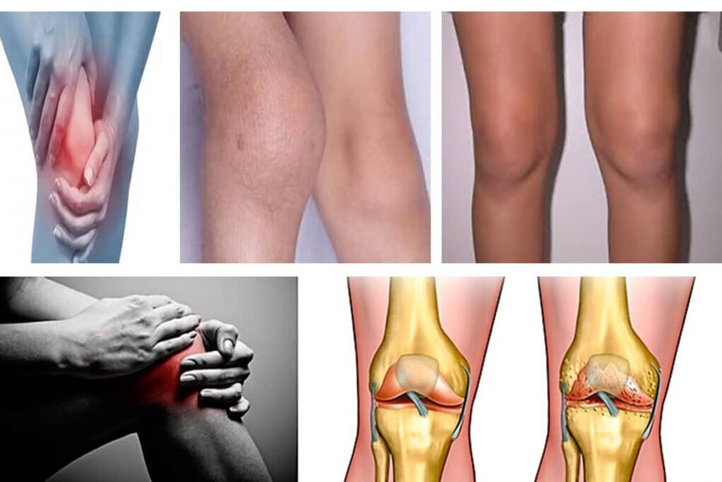 What is arthrosis