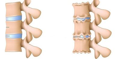 How to recognize the existence of Lomber's osteocondrosis