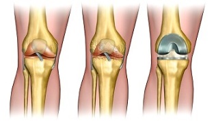 endoprosthetic for osteoarthritis of the knee joint