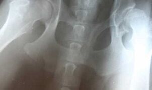 symptoms and treatment of hip osteoarthritis